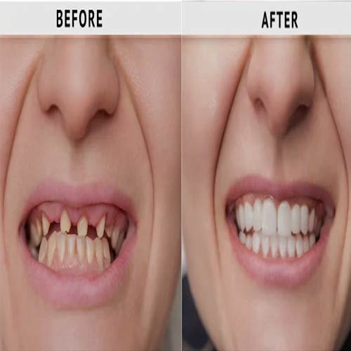 Veneer Result 1