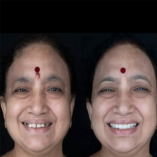 Veneer Result 2