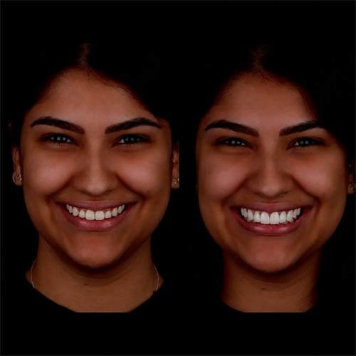 Veneer Result 3
