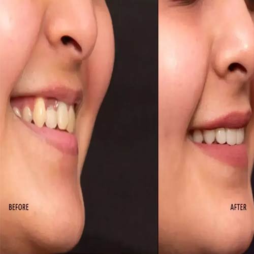 Veneer Result 4