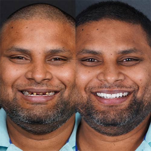 Veneer Result 5
