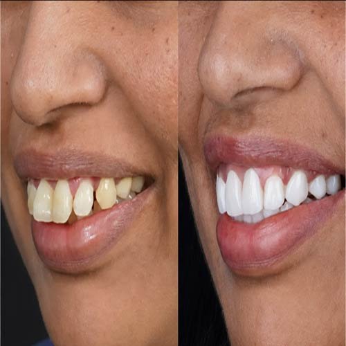 Veneer Result 7