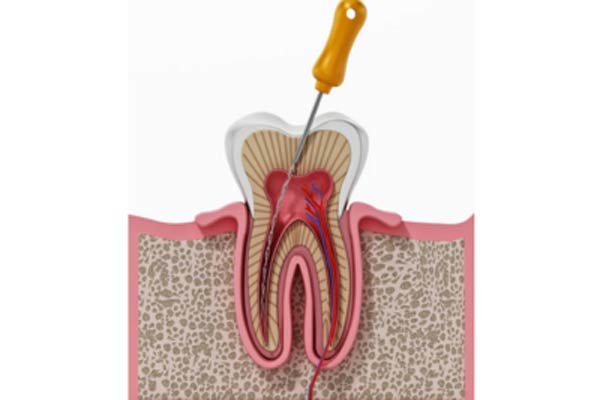 Apicoectomy (Root-End Surgery)