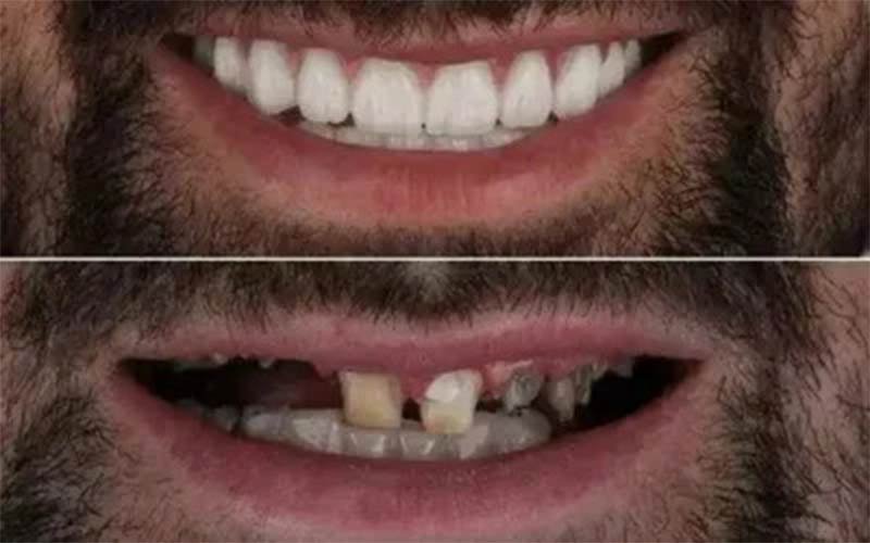 Full Mouth Rehabilitation
