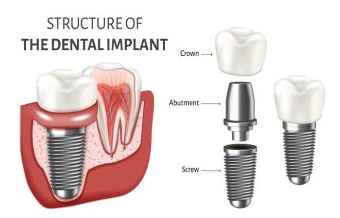 Structure of the Dental Implant - Crown, Abutment, Screw