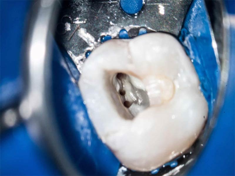 Microscopic Endodontics