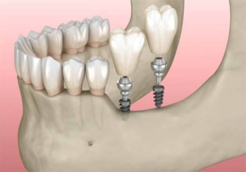 Mini Dental Implants (MDIs)