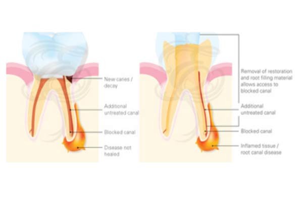 Laser-Assisted Root Canal