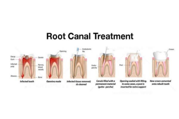 Single-Sitting Root Canal
