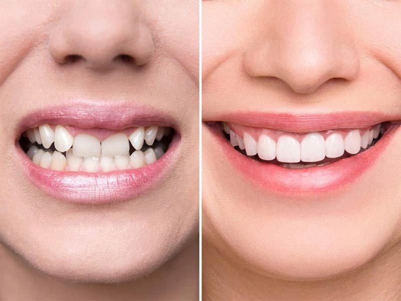 Full Mouth Rehabilitation