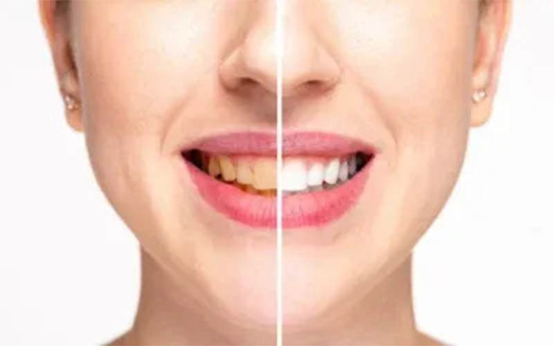 Smile Makeover
