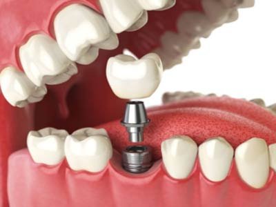 Implant Placement