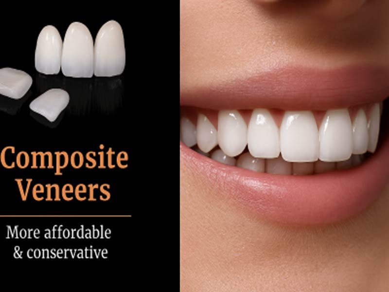 Composite Veneers